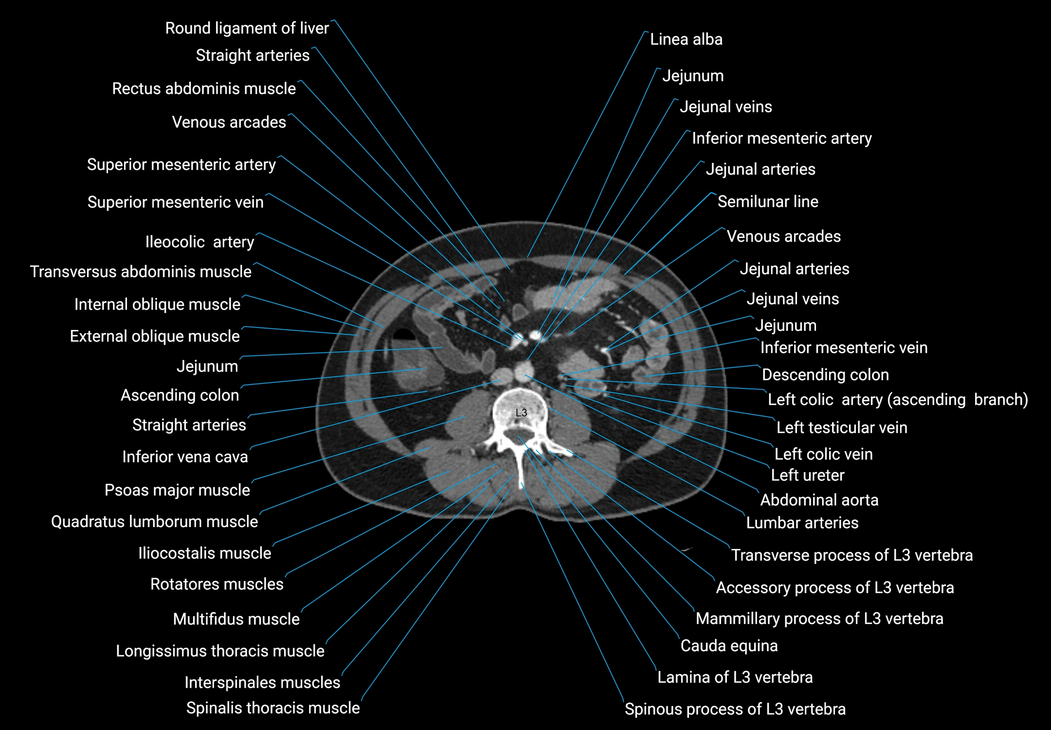 CT male pelvis axial cross sectional anatomy labelled radiology image -00091.webp